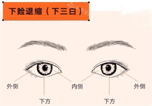 眼修復(fù)下瞼退縮 眼修復(fù)下瞼退縮
