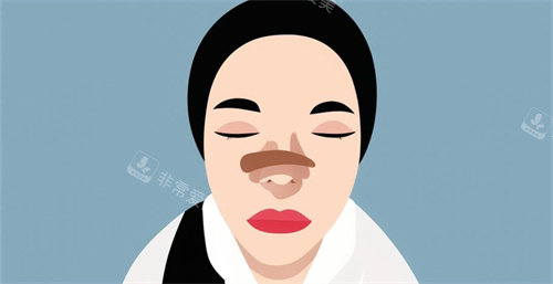 隆鼻手術(shù)后腫脹動(dòng)畫 隆鼻手術(shù)后腫脹動(dòng)畫