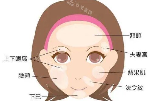 面部可以脂肪填充的部位卡通圖 面部可以脂肪填充的部位卡通圖