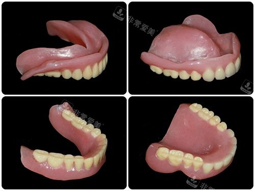 全口吸附性义齿实物展示图