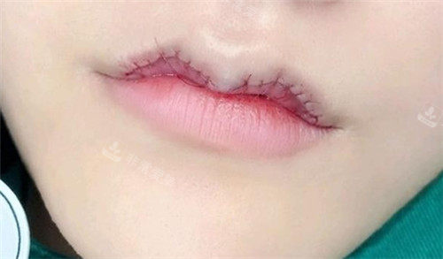 微笑唇手术缝合图片