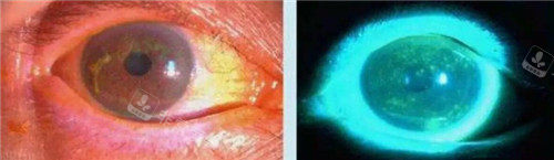 干眼症眼球图片