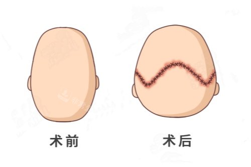 后脑勺整形卡通对比图 后脑勺整形卡通对比图