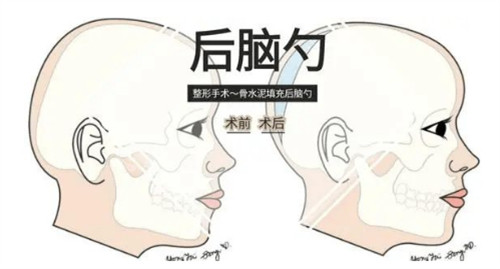 后脑勺填充对比 后脑勺填充对比