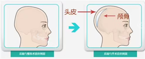 后脑勺填充层次 后脑勺填充层次