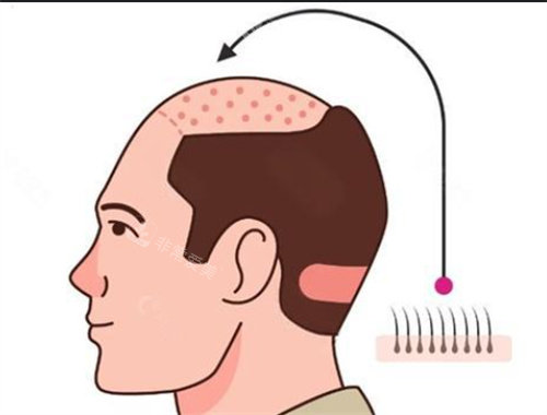 毛发种植 毛发种植