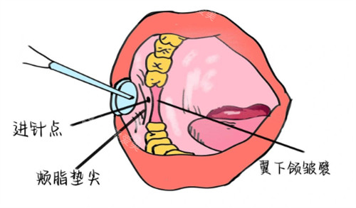 牙周内注射麻醉