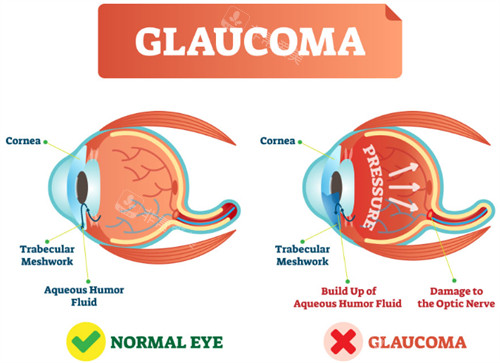 正常眼睛和青光眼的对比