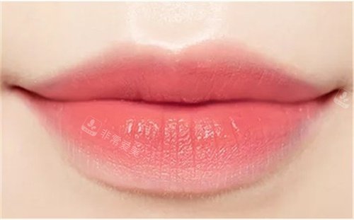 唇部整形图片 唇部整形图片
