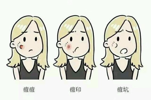 痘印痘坑卡通图