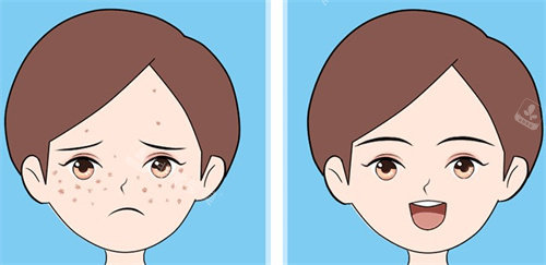 激光祛斑對(duì)比 激光祛斑對(duì)比