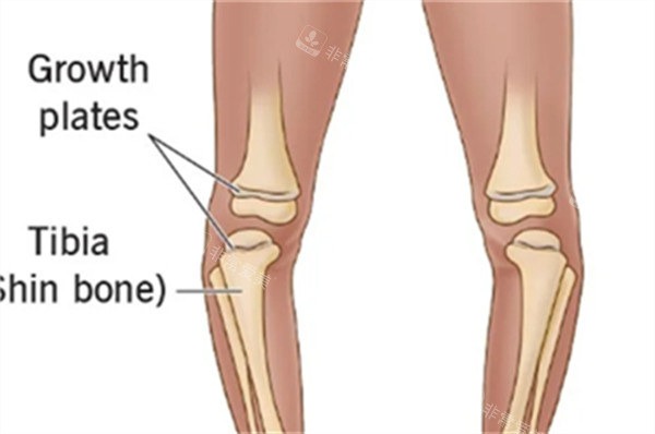 O型腿的樣子圖解