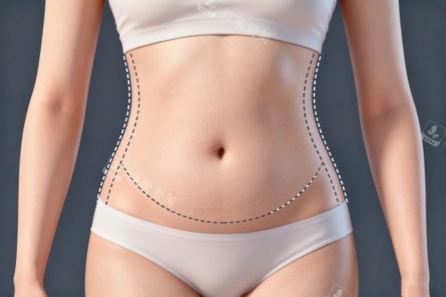 腹部做吸脂塑形图片展示