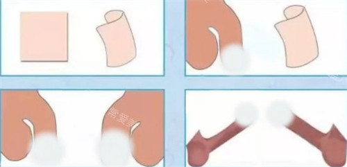 阴茎生物补片手术前后对比