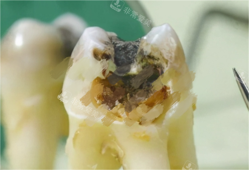 烂牙齿图片展示