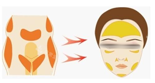 自体脂肪面部填充示意图