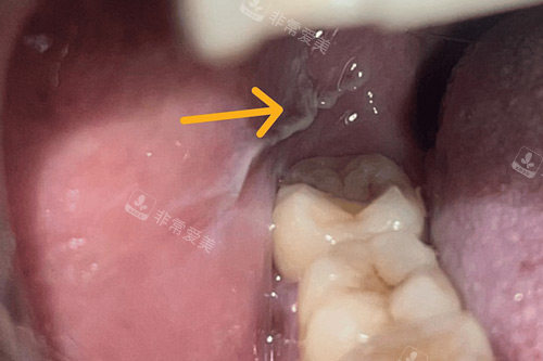 牙齿白色伪膜示意图