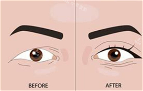 双眼皮手术前后对比 双眼皮手术前后对比