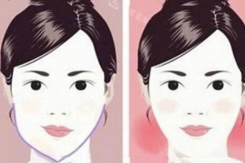 脸型不对称矫正前后对比图