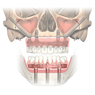全口穿颧种植牙透视图