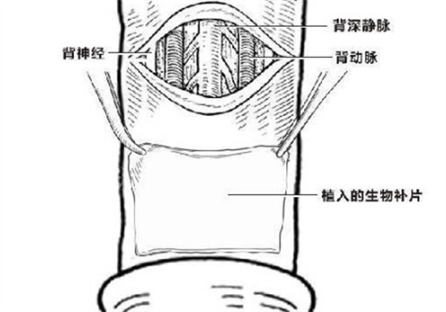 阴茎生物补片创口位置