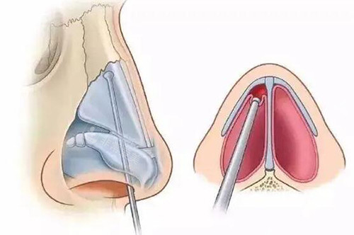 长沙谭骛远医生技术怎么样？做鼻子整形技术和审美都很在线的一位医生！