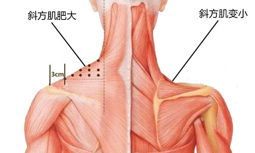 斜方肌注射前后展示图