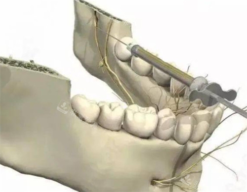 牙周内注射麻醉的入针点