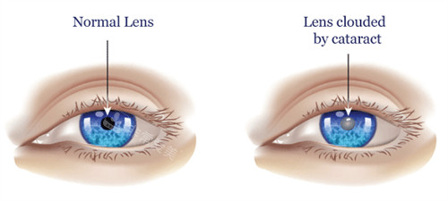 正常眼睛和白内障眼睛的区别