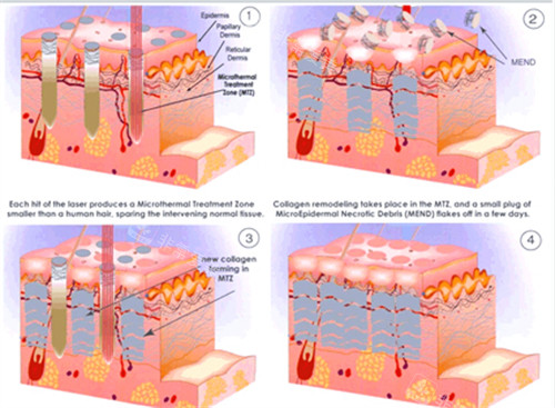 改善皮肤疤痕 改善皮肤疤痕