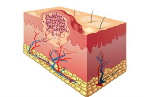 疤痕疙瘩 疤痕疙瘩