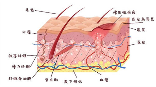 增生疤痕是怎么形成的 增生疤痕是怎么形成的