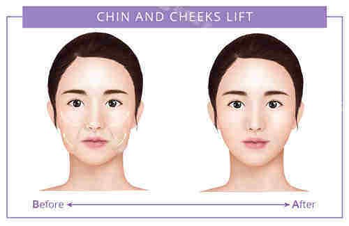 面部提升對比圖 面部提升對比圖