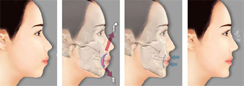 双鄂手术前后对比图片