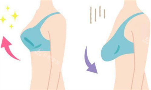 票选广州乳房悬吊手术医生排名榜：刘杰伟、朱云、郝永生、许扬滨做乳房悬吊手术技术好！