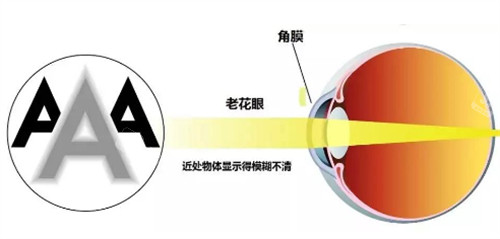 老花眼眼球的变化图片