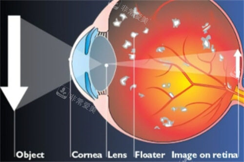 飞蚊症眼球结构示意图