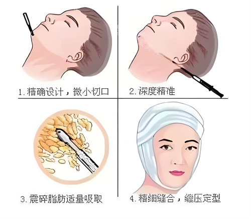 面部吸脂步驟動畫演示圖 面部吸脂步驟動畫演示圖