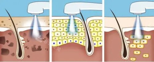 光子嫩膚的過(guò)程 光子嫩膚的過(guò)程