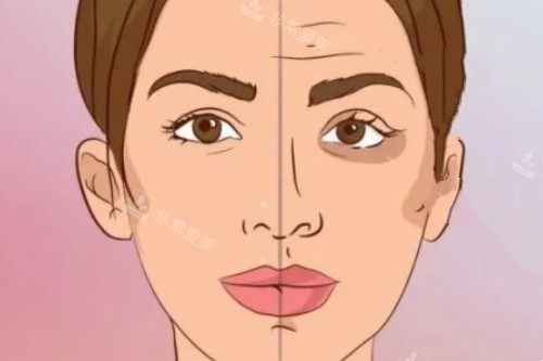 脸部做针剂提升卡通图 脸部做针剂提升卡通图