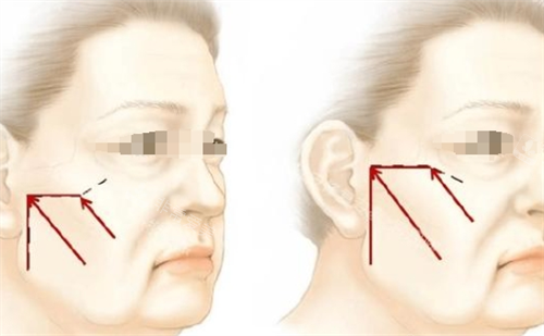 微拉美面部提升方向