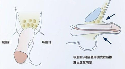 吸脂增大陰莖照片 吸脂增大陰莖照片