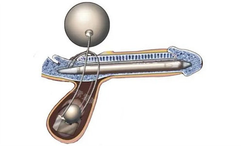 陰莖植入 陰莖植入