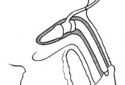 男性私密整形假體植入陰莖卡通示意圖 男性私密整形假體植入陰莖卡通示意圖