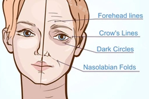 人體衰老形成的不同皺紋 人體衰老形成的不同皺紋