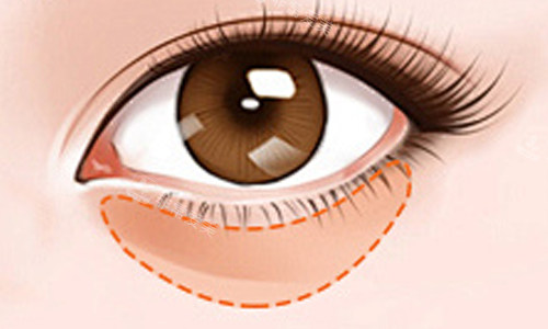 眼袋位置及顏色展示 眼袋位置及顏色展示