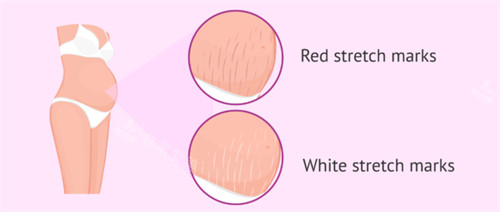 妊娠紋疤痕漫畫圖疤痕