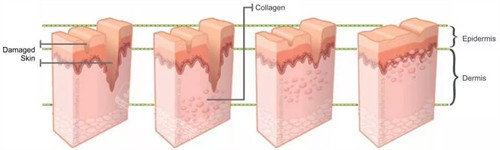 凹陷疤痕填充前后對(duì)比 凹陷疤痕填充前后對(duì)比