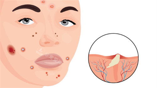 祛痘图片 祛痘图片
