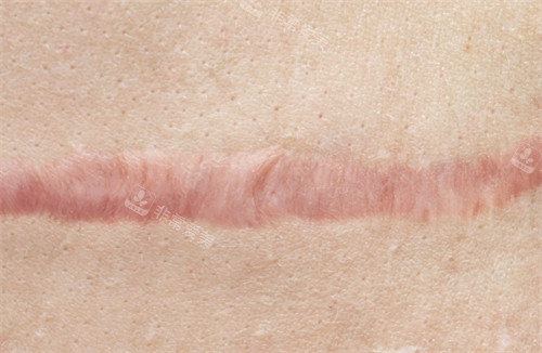 凸起疤痕 凸起疤痕